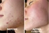 Bio Spicule Microneedling Skin Treatment