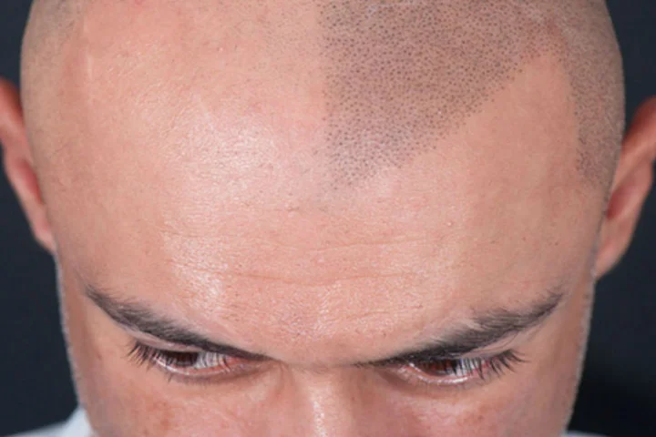 Scalp Micropigmentation